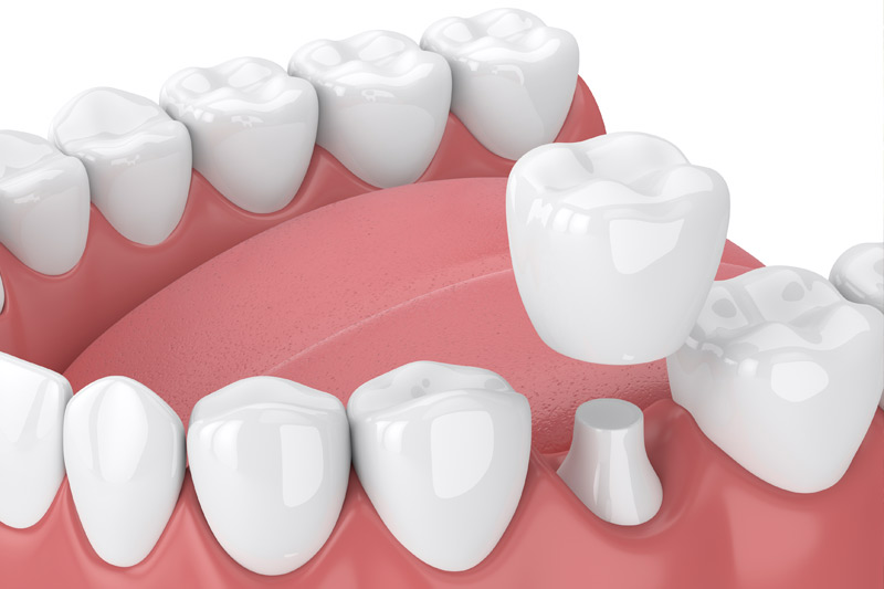 Dental Crowns in Fishers