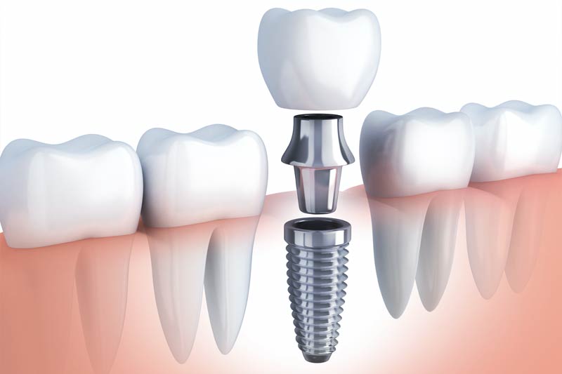 Implants Dentist in Fishers