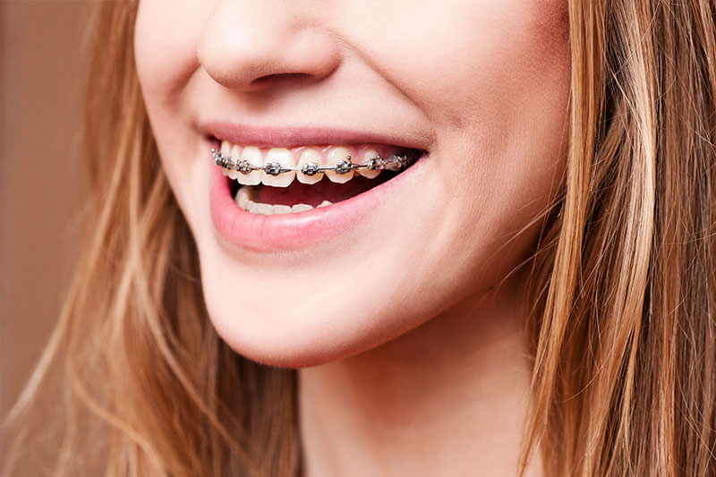 Orthodontics in Fishers