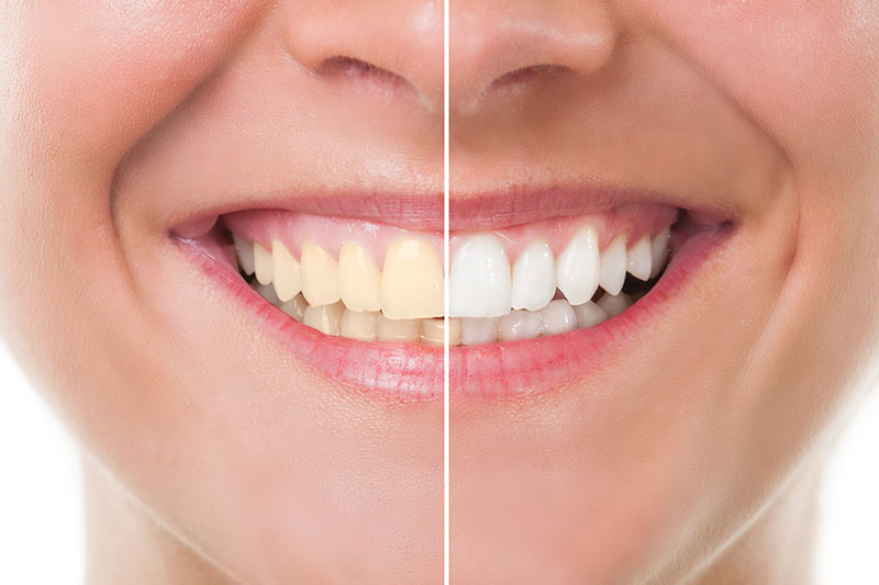 Teeth Whitening in Fishers